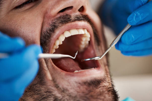 Best Knocked-Out Tooth (Avulsed Tooth) Treatment in Warrenton, VA